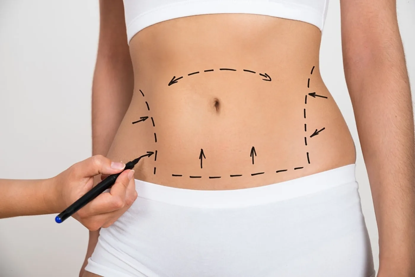Abdominoplastia